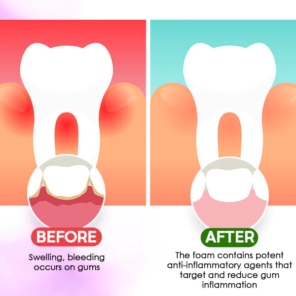 DentiCare™ Gum Treatment Foam (TEST)