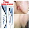 Remove Burn Scars Cream Gel