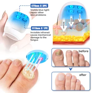 Furzero™ Nail Fungus Cleaning Laser Relief Device