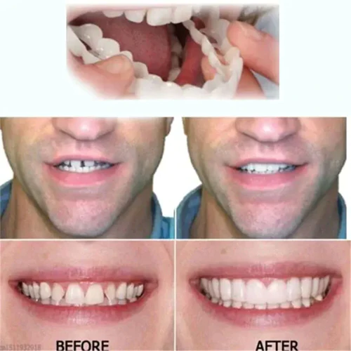 Nurbini™ ProX Adjustable Snap-On Dentures